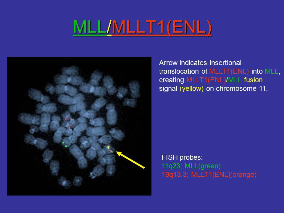 FISH showing MLL/MLLT1 (ENL) insertional translocation